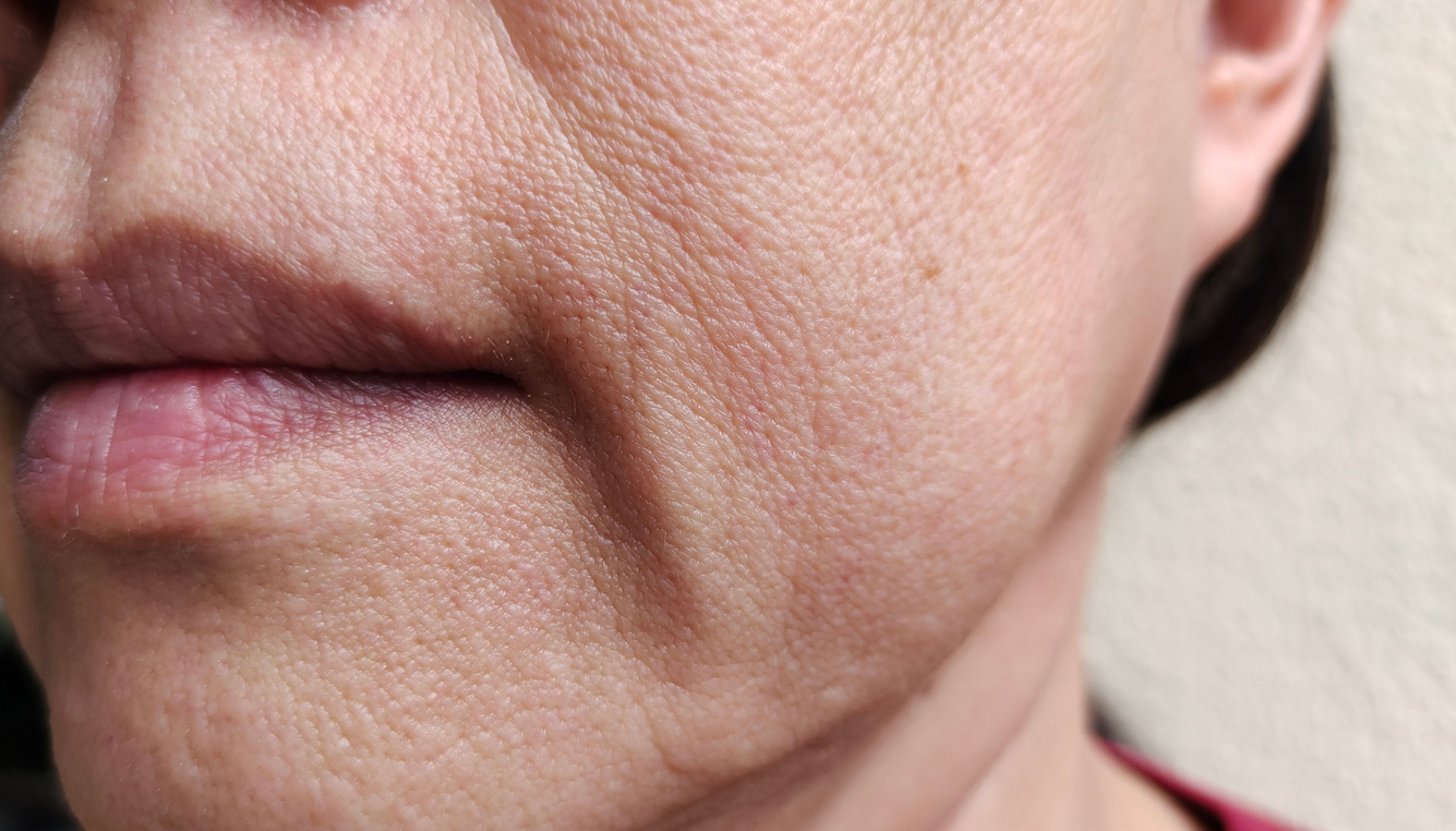 The flabbiness adipose sagging skin beside the mouth, wrinkles and flabby of smile lines.