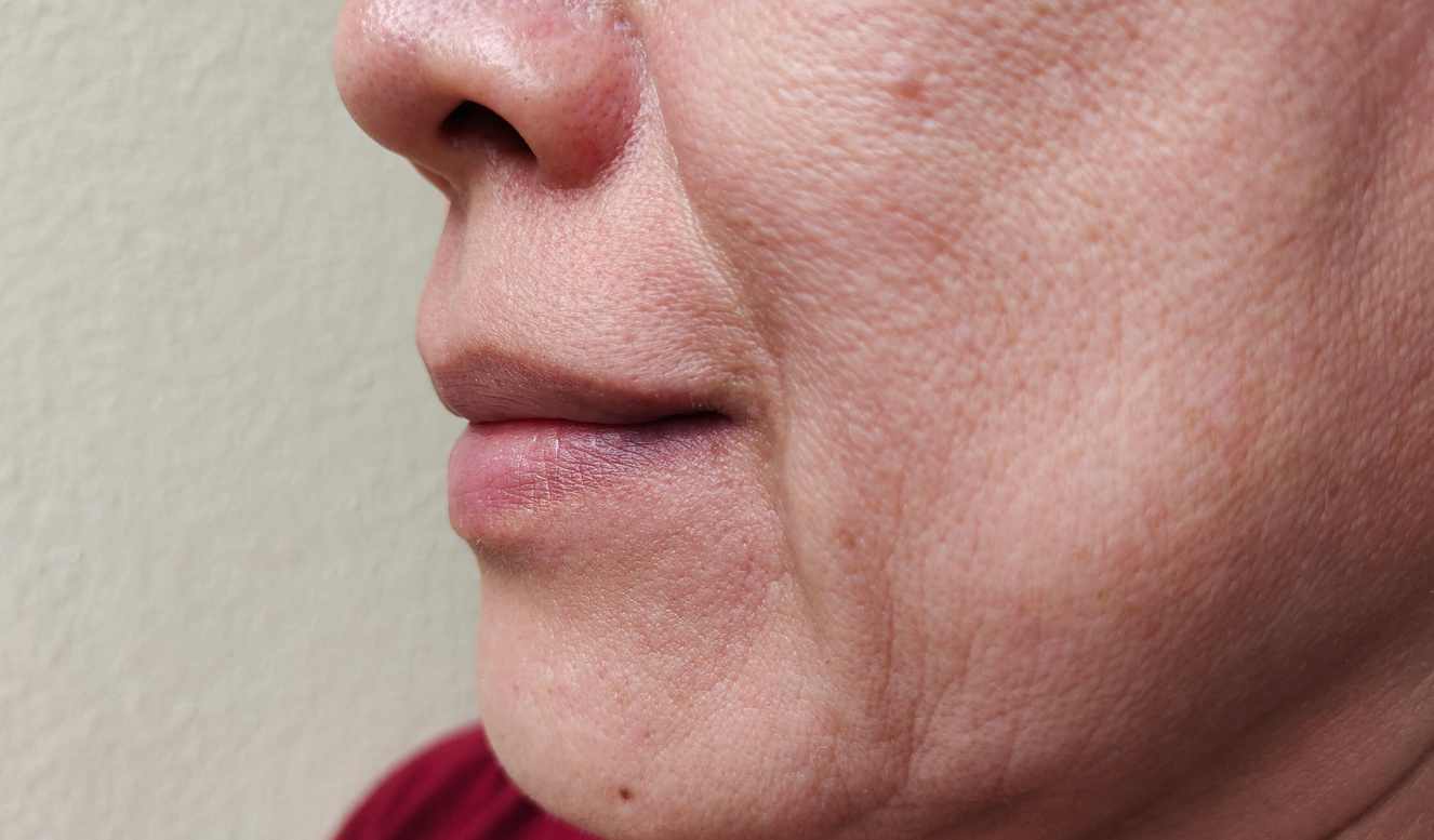 The flabbiness adipose sagging skin beside the mouth, wrinkles and flabby of smile lines.